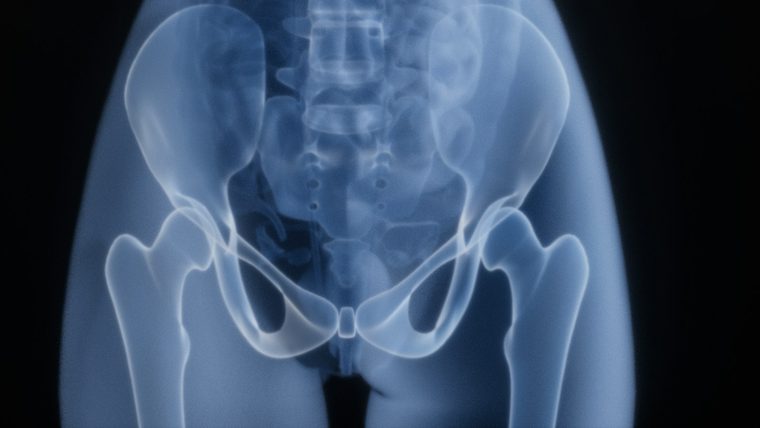 Where a femur breaks in a fall