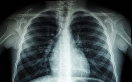 Optical ultrasound for lung-cancer diagnosis