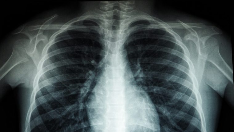 Optical ultrasound for lung-cancer diagnosis